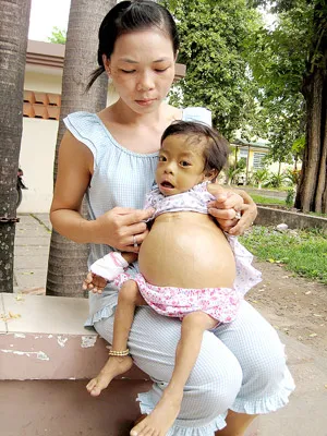 Cháu bé 3 tuổi mang nhiều bệnh hiểm