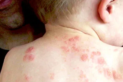 Vết đốt, cắn của côn trùng - Nhỏ nhưng nguy hiểm