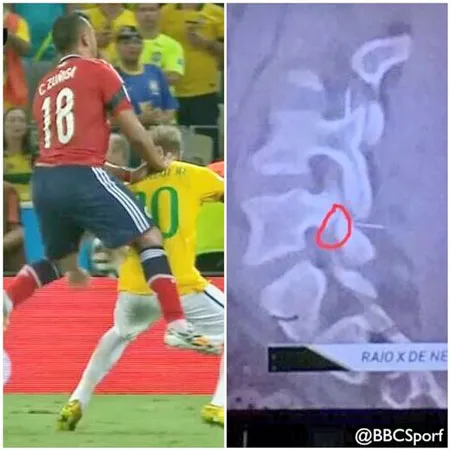 Kết quả chụp phim (phải) cho thấy vết rạn ở đốt xương sống thứ 3.