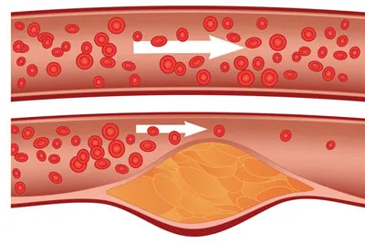 Ở trên là mạch máu khỏe và phía dưới là mạch máu bị nghẽn do đóng nhiều Cholesterol.