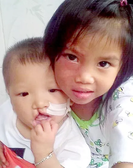 Mỏi mòn vì 2 con thơ dị tật bẩm sinh