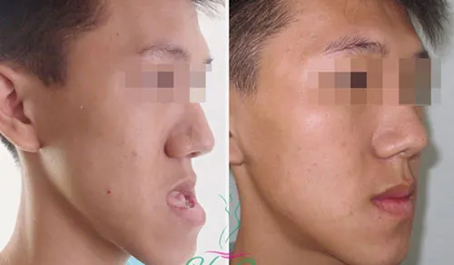 “Giải cứu” chàng trai 5 năm không khép được miệng