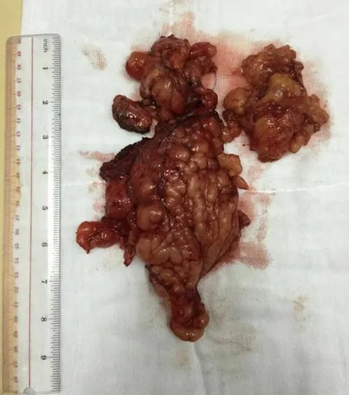 Can thiệp thành công ca u sợi thần kinh phức tạp và hiếm gặp