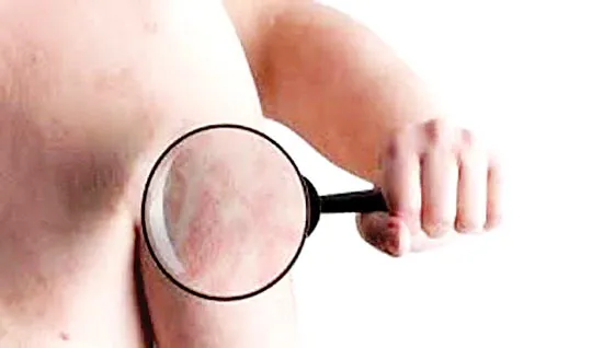 Hướng điều trị vảy nến trong tương lai