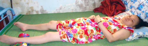 Liệt giường 13 năm vì gãy cột sống cổ
