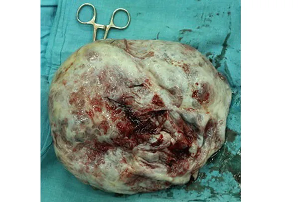 Cần Thơ: Phẫu thuật thành công khối u nang nặng 4kg