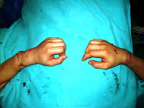 Nối liền thành công hai tay bị đứt rời