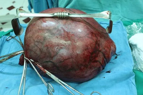 Cần Thơ: Phẫu thuật thành công khối u xơ tử cung nặng 7,8 kg