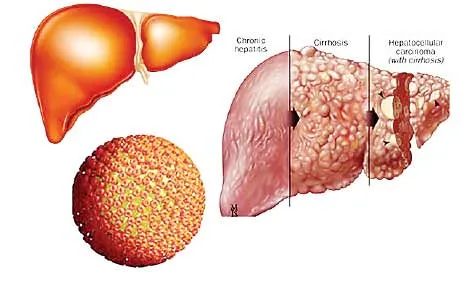Viêm gan virus - bệnh nguy hiểm, dễ bỏ qua