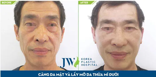 Trẻ hóa toàn diện khuôn mặt cho người có tuổi