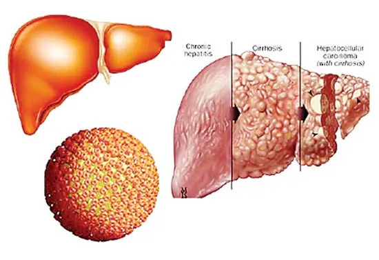 Viêm gan virus - bệnh nguy hiểm, dễ bỏ qua