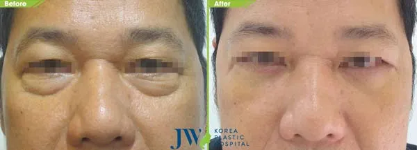 Phẫu thuật Midface - xóa nếp nhăn vùng mặt hiệu quả