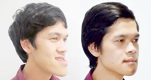 Phẫu thuật thành công thầy giáo bị khuyết tật móm nặng