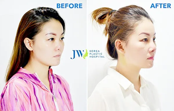 Bệnh nhân Singapore sang Việt Nam để sửa mũi hỏng