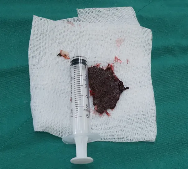 Cứu sống thanh niên bị mảnh lưỡi cưa găm vào sọ não