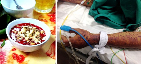 The Ministry warns of streptococcus because people eat raw swine blood budding (Photo: SGGP)