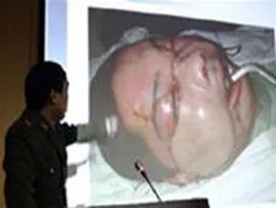 Thực hiện thành công ca ghép mặt