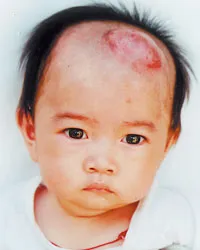 Bé Hiếu mang căn bệnh hiểm nghèo