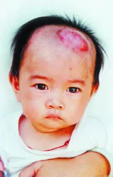 Bé Hiếu mang căn bệnh hiểm nghèo