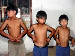 ° 4 tiêu chuẩn chẩn đoán xơ hóa cơ Delta