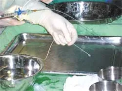 Phương pháp mới điều trị rò động mạch cảnh- xoang hang