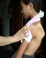 Hỗ trợ kinh phí phẫu thuật cho người nghèo bị teo cơ Delta