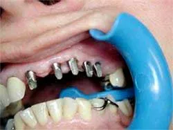 Implant - Giải pháp tối ưu cho bệnh nhân mất răng