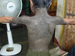 Mắc bệnh bớt sắc tố diện rộng