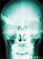 Cứu sống một bệnh nhân bị đâm thủng não