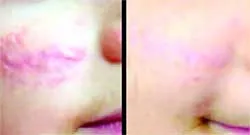 Điều trị sẹo lồi