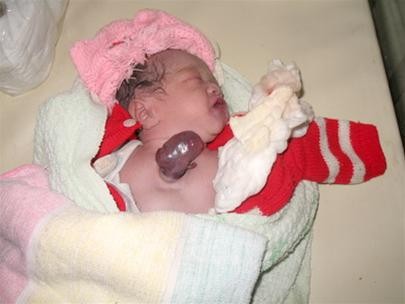 The baby with heart outside chest dies