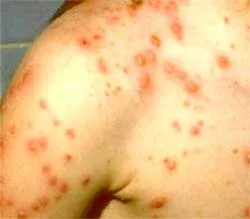 Tiêm chủng để phòng ngừa