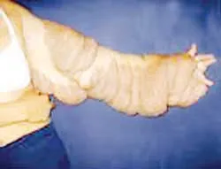 Cắt bỏ khối u trên tay nặng gần 6 kg