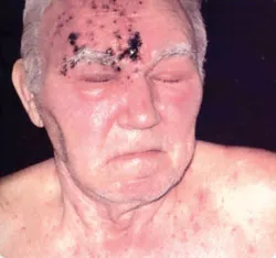 Đừng xem thường bệnh Zona ảnh 2