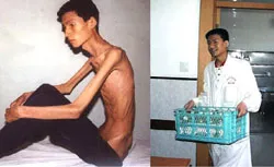 Người được ghép ruột cưới vợ