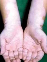 Chữa bạch biến bằng quang trị liệu