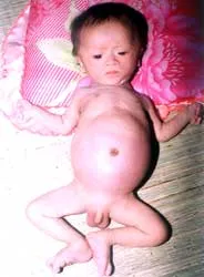 Cháu Tăng Thiện Đăng bị căn bệnh hiểm nghèo