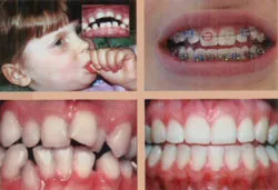 Chỉnh nha trẻ em: Khi nào bắt đầu