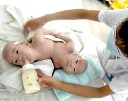 Trung Quốc:Tách thành công 2 bé gái dính liền