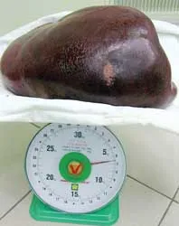Cắt thành công lá lách nặng 6,5kg cho bệnh nhân 43 tuổi