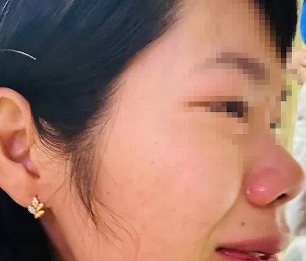 Cô Quy bị hành hung gây chấn thương vùng mặt và chảy máu mũi