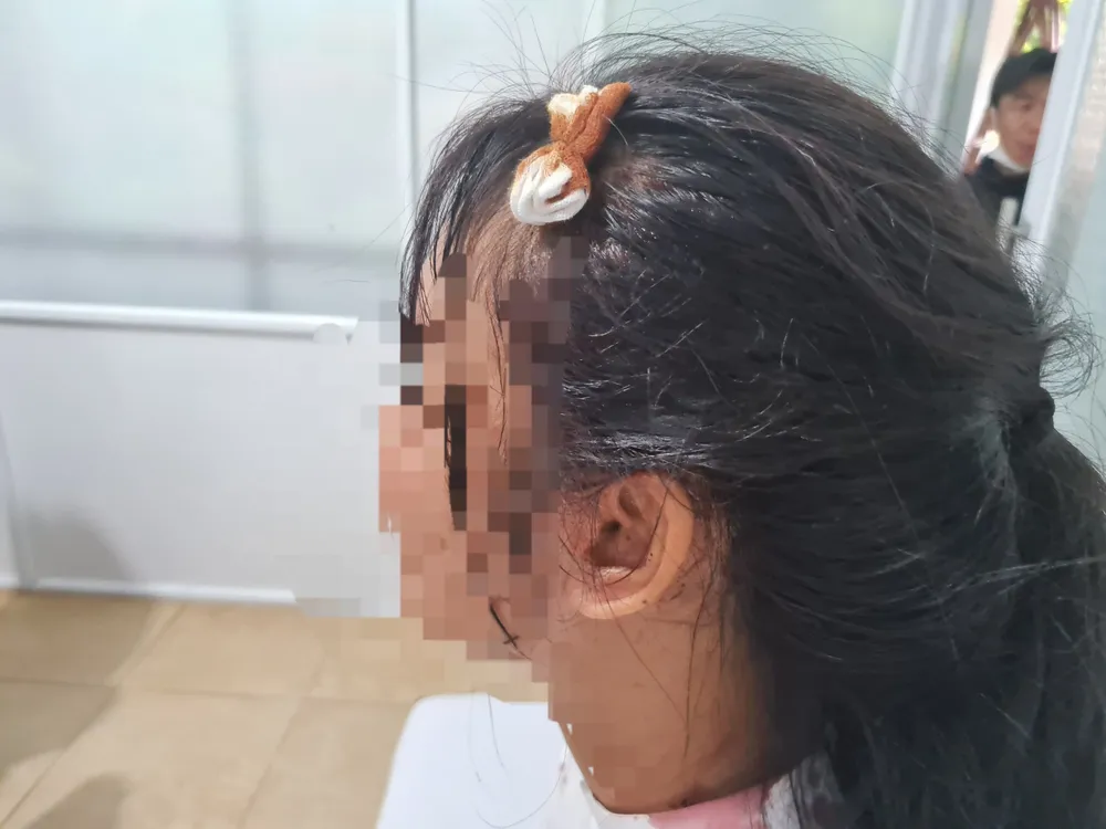 Em M.T. bị đánh đến toác đầu, phải khâu 4 mũi