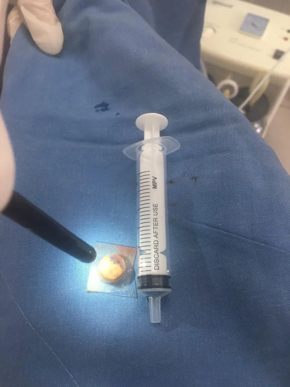 Ho kéo dài do dị vật đường thở ảnh 4