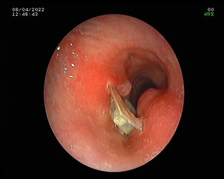 Ho kéo dài do dị vật đường thở ảnh 3