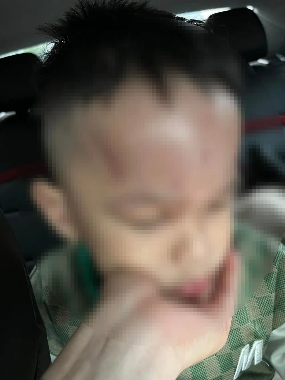 Cháu L. được bệnh viện chẩn đoán viêm mô mềm vùng da trán/đụng dập mô mềm vùng trán