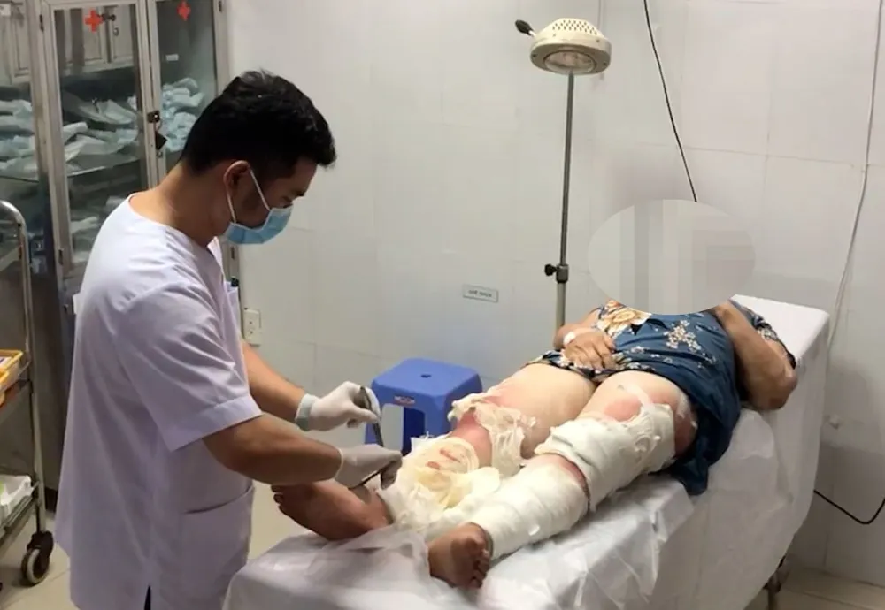 Hơn 1 tháng sử dụng các loại lá không được kiểm chứng, phần lưng, hai chân và mông của người này bắt đầu có biểu hiện ngứa và các nốt bỏng bắt đầu lan rộng Hơn 1 tháng sử dụng các loại lá không được kiểm chứng, phần lưng, hai chân và mông của người này bắt đầu có biểu hiện ngứa và các nốt bỏng bắt đầu lan rộng