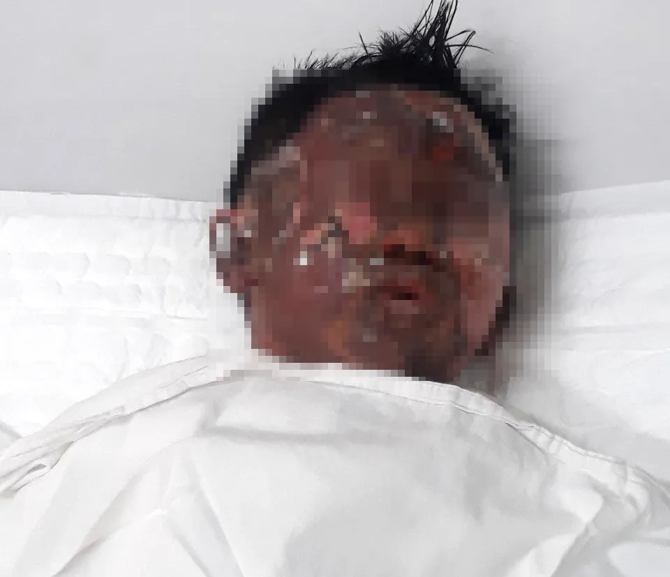 Hiện tình trạng của bệnh nhi N.T.V đang diễn tiến nên chưa thể đánh giá được toàn diện tổn thương