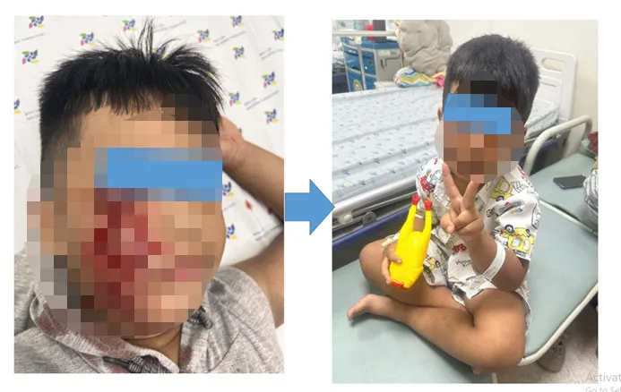 Hiện tình trạng cháu K. cải thiện dần, trẻ được tiếp tục liệu trình tiêm vaccine ngừa dại