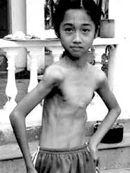 Nghiên cứu bệnh teo cơ Delta ở Hà Tĩnh