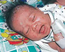 Bệnh thủy đậu gia tăng